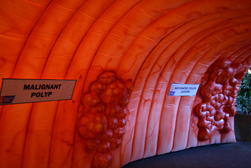 A large-scale colon showing a small growth labeled malignant polyp and a larger growth labeled advanced colon cancer